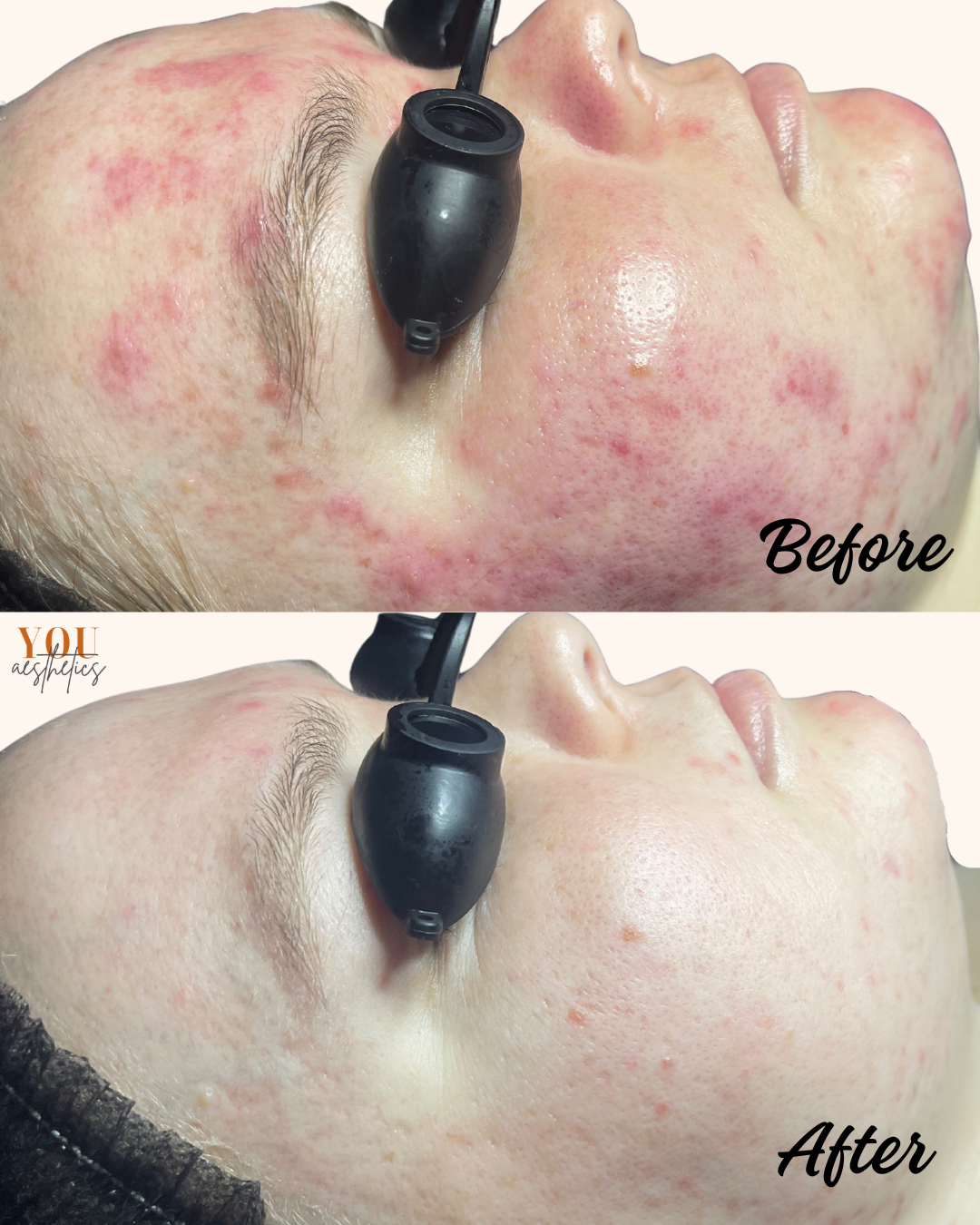 Before-and-after close-up of facial skin: red, irritated cheeks improve to smoother, clearer skin.