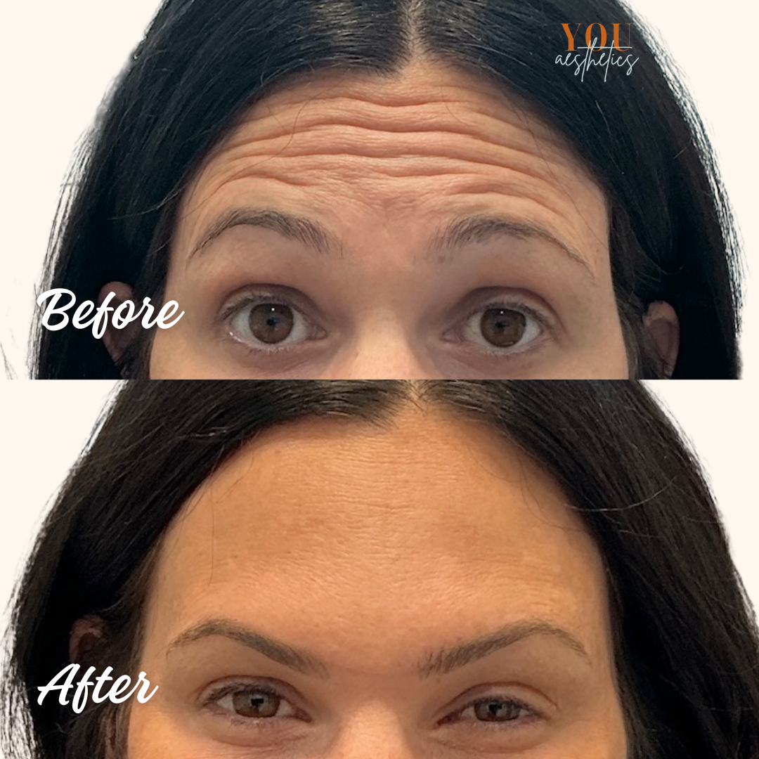 Split-face before-and-after close-up of a forehead, showing smoother skin after treatment