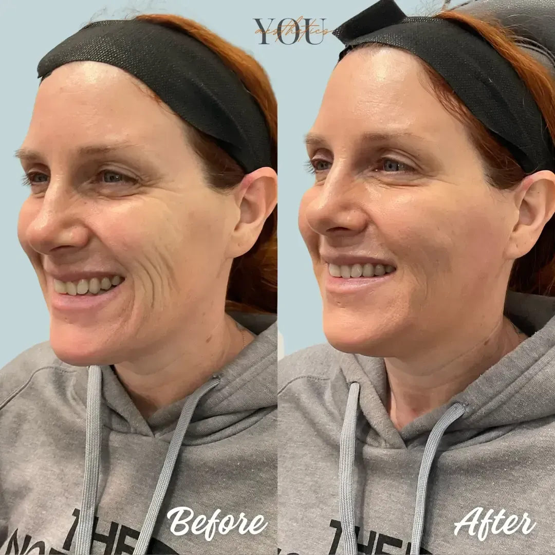 Side-by-side smiling woman in gray hoodie, labeled “Before” and “After” against a plain background.