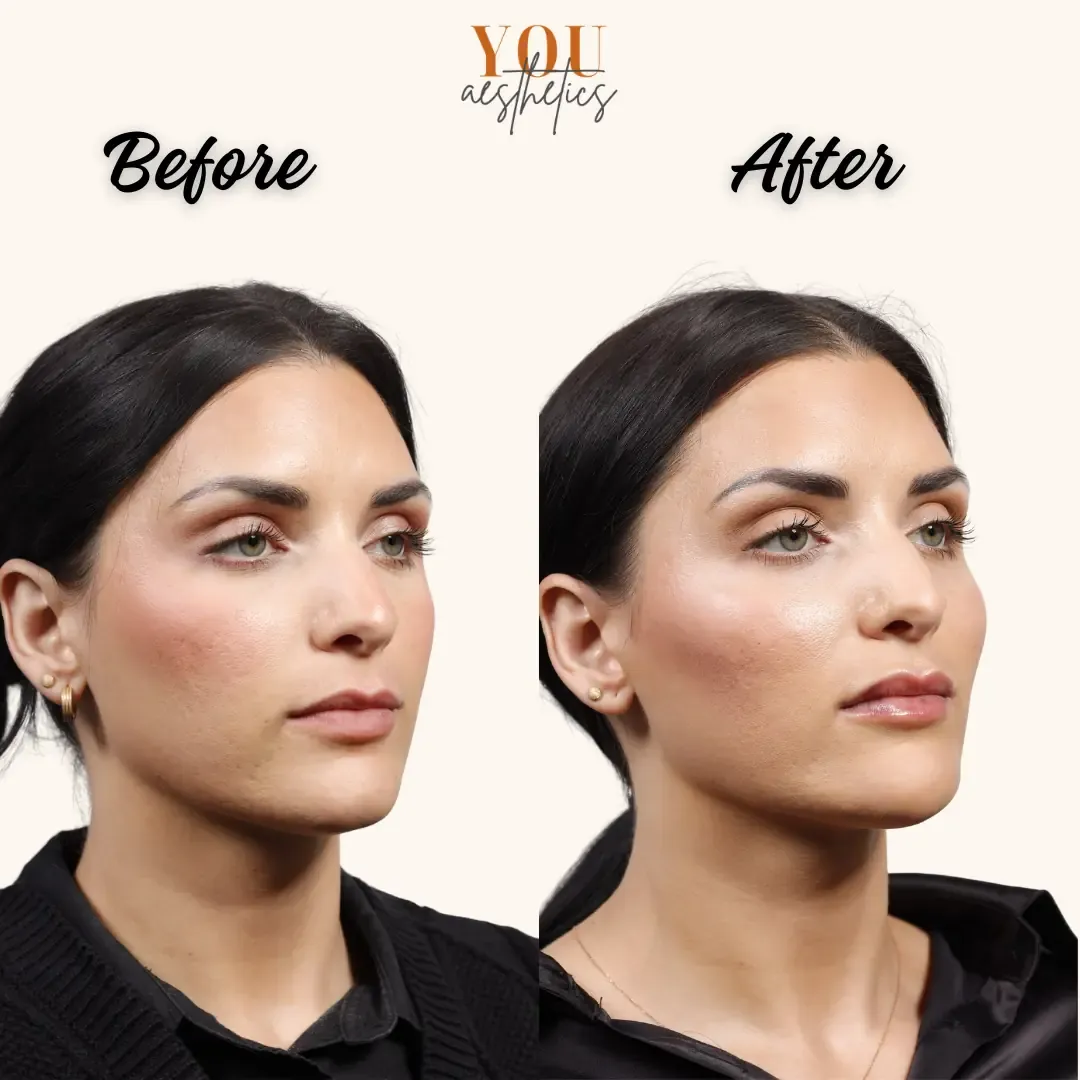 Before-and-after cosmetic facial comparison of a woman against a plain background.