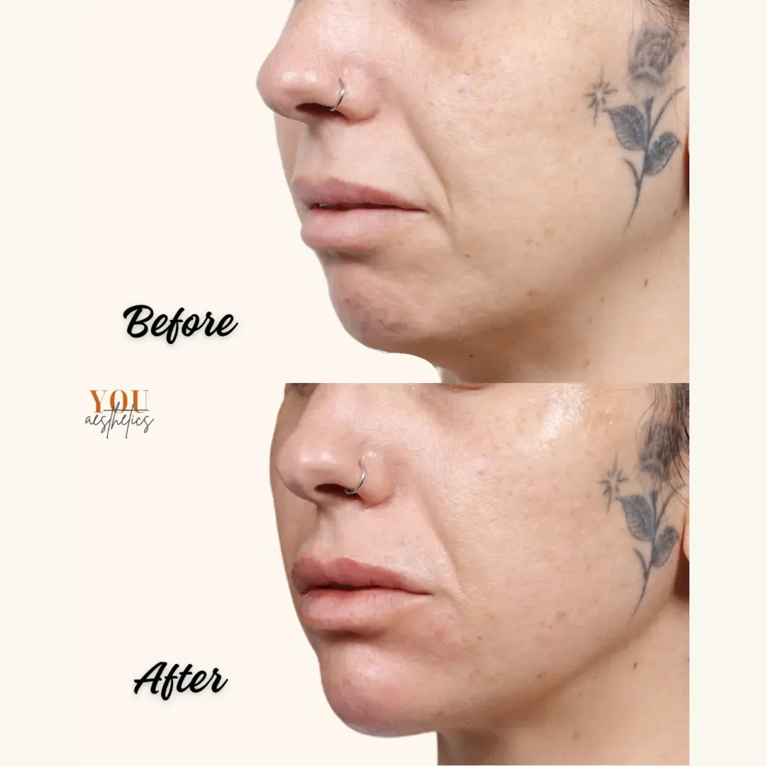 Before-and-after side-profile close-up showing a nose and chin contour change.
