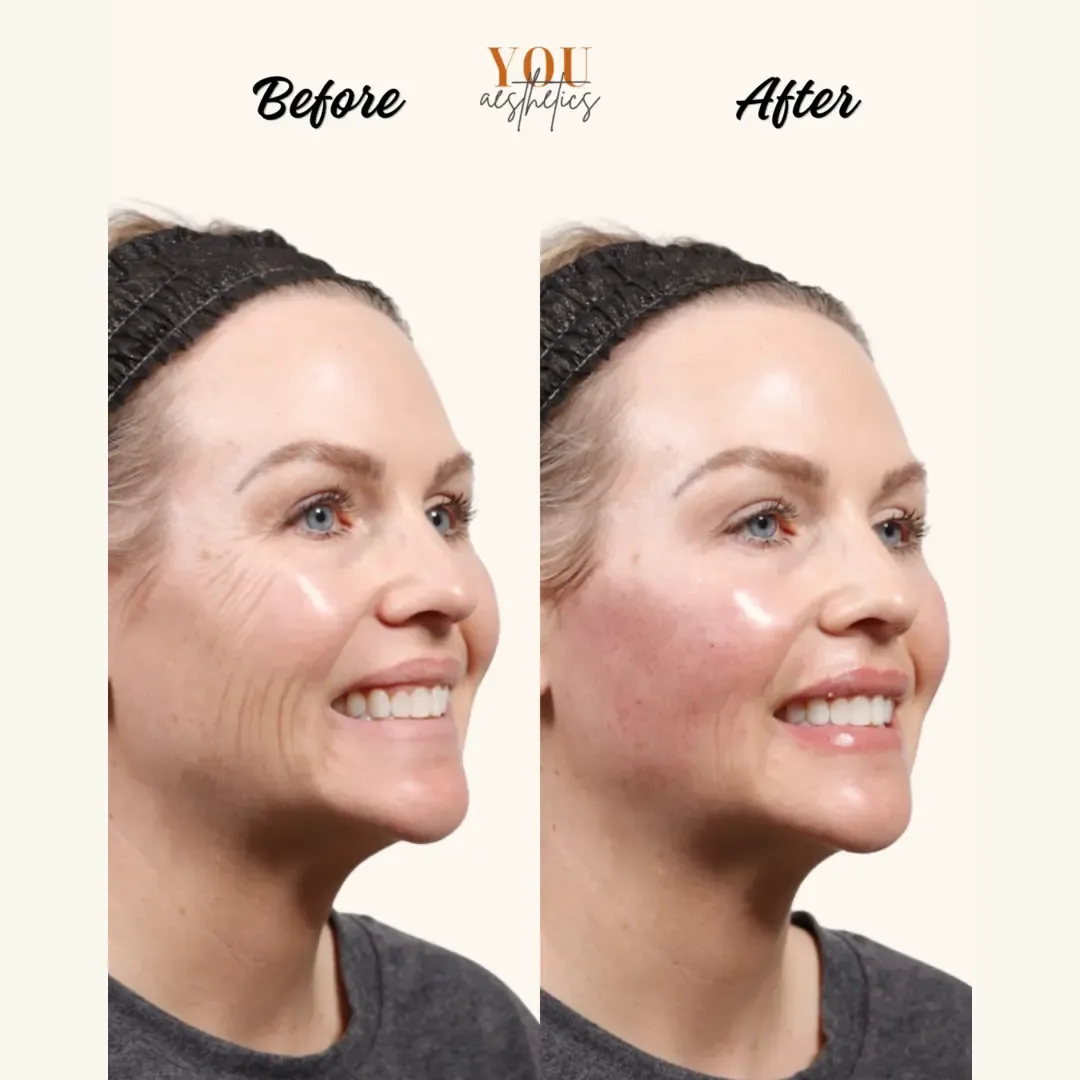 Before-and-after facial photos of a smiling woman, showing smoother skin and a rosy cheek after treatment