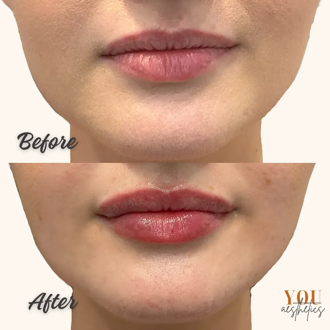 Lip close-up comparison showing natural lips above and glossier, fuller lips below.