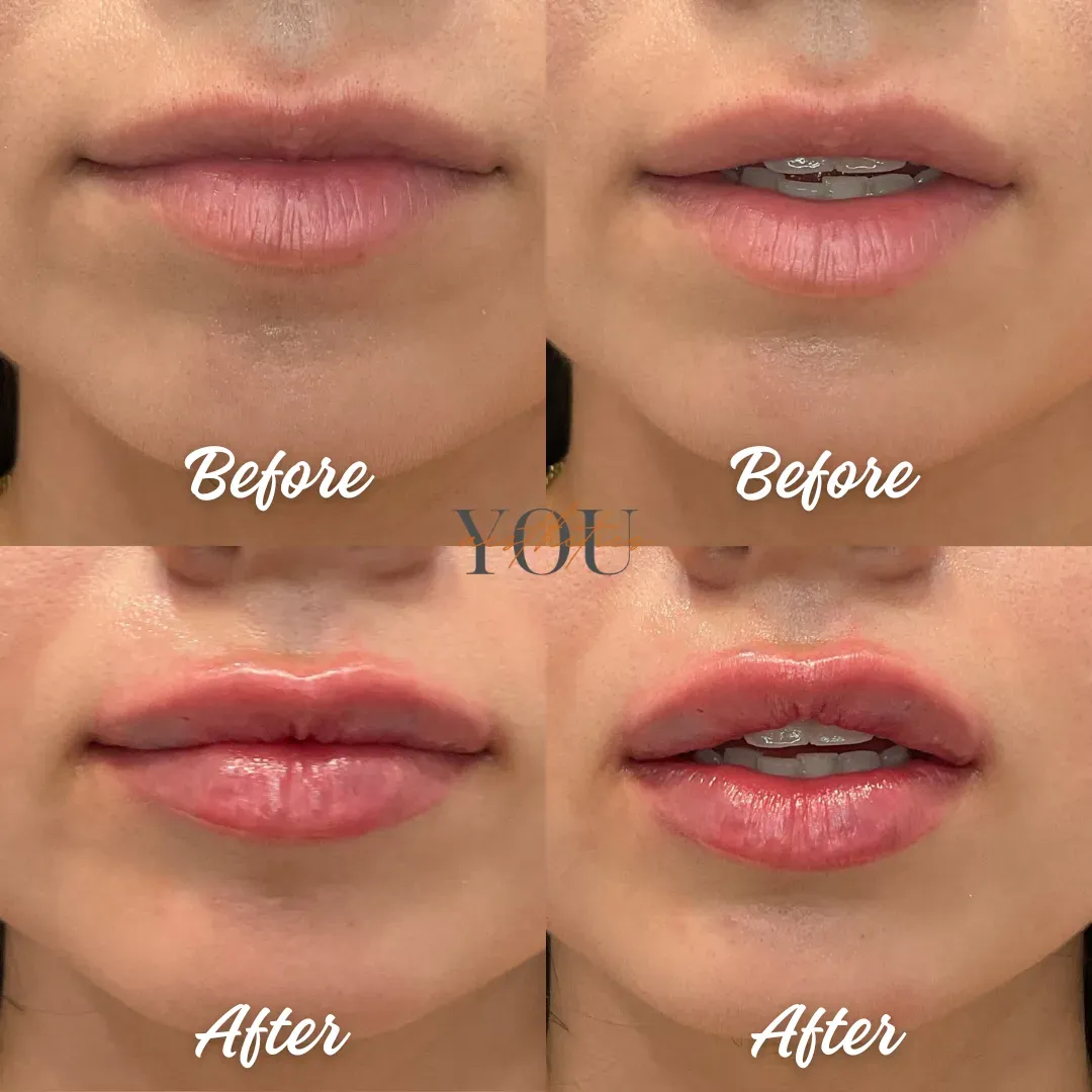 Lip gloss comparison showing bare lips before and glossy pink lips after, with teeth visible in one before shot