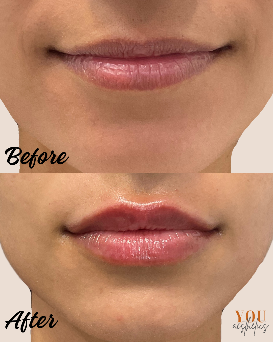 Before-and-after close-up of lips showing subtle cosmetic enhancement and gloss.