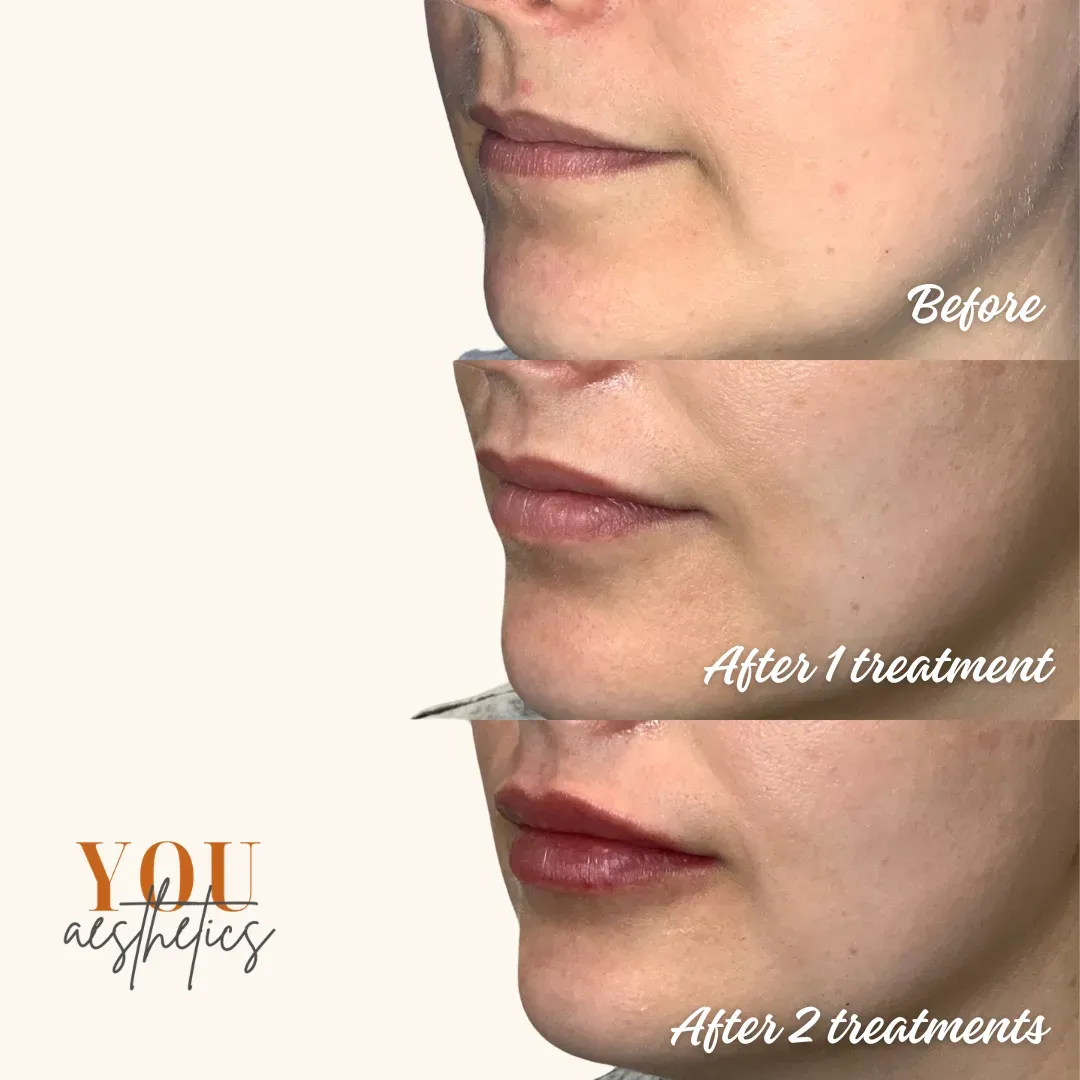 Three close-up side-profile lip photos labeled before, after 1 treatment, and after 2 treatments.