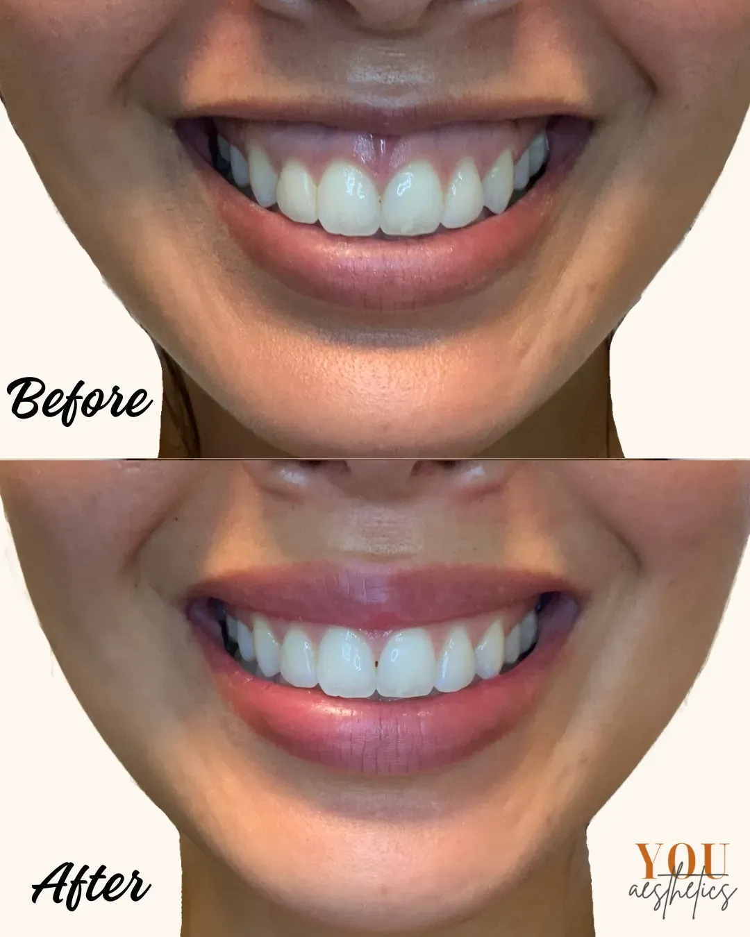 Before-and-after close-up of a smiling mouth showing whiter teeth and pinker lips.