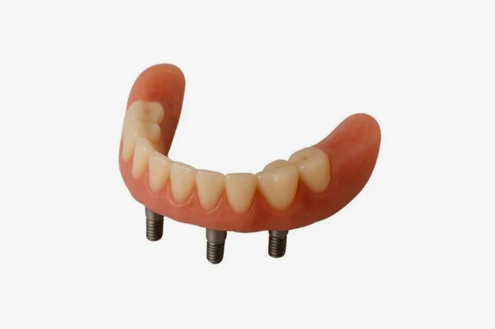Upper dental bridge with teeth and three implant posts, pink gum, and white background.