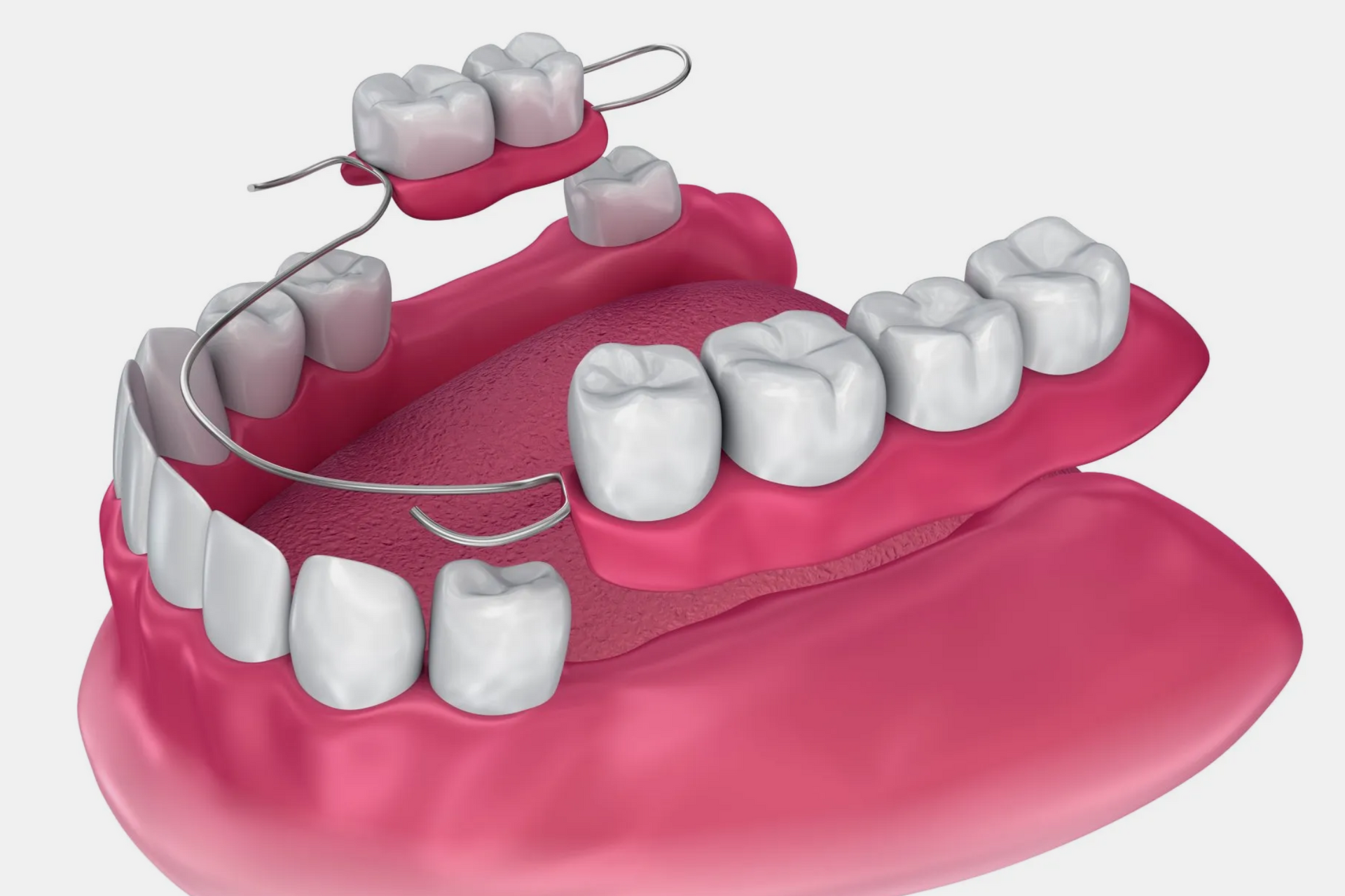 Partial denture model showing replacement teeth attached to surrounding teeth with metal wires.
