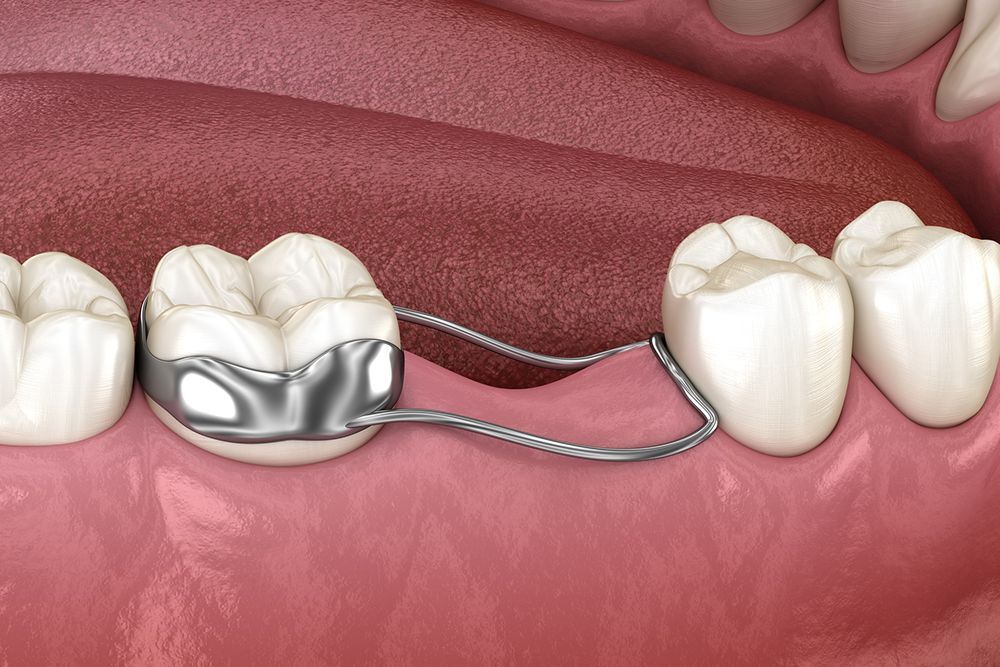 Dental illustration: silver space maintainer attached to molars in mouth.