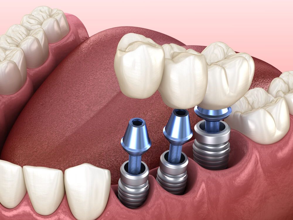 A close up of a person 's mouth with dental implants in it.