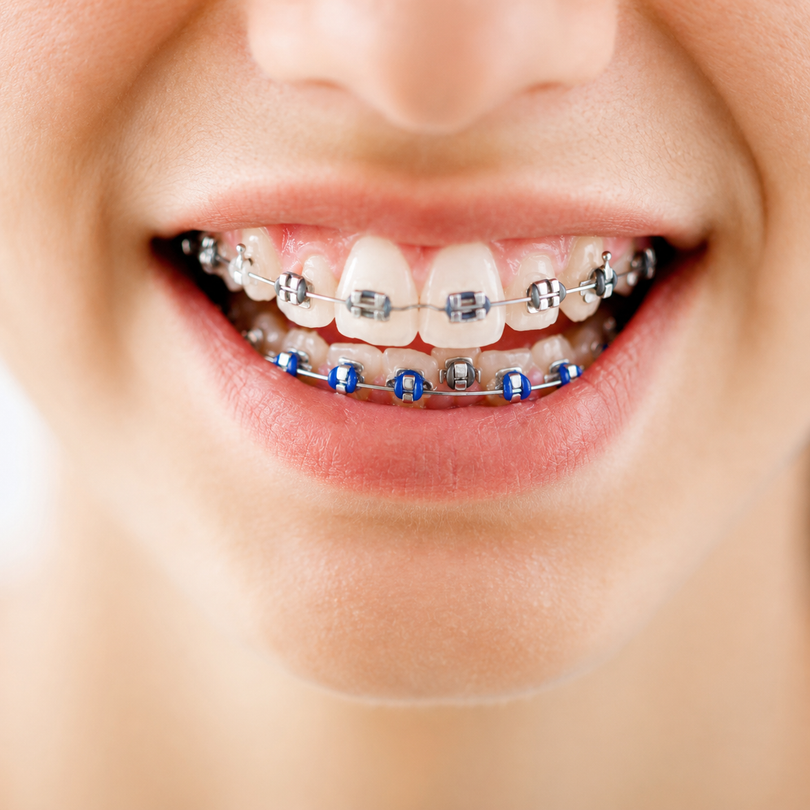 Professionista dentistico che illustra un modello ortodontico a un paziente in uno studio luminoso