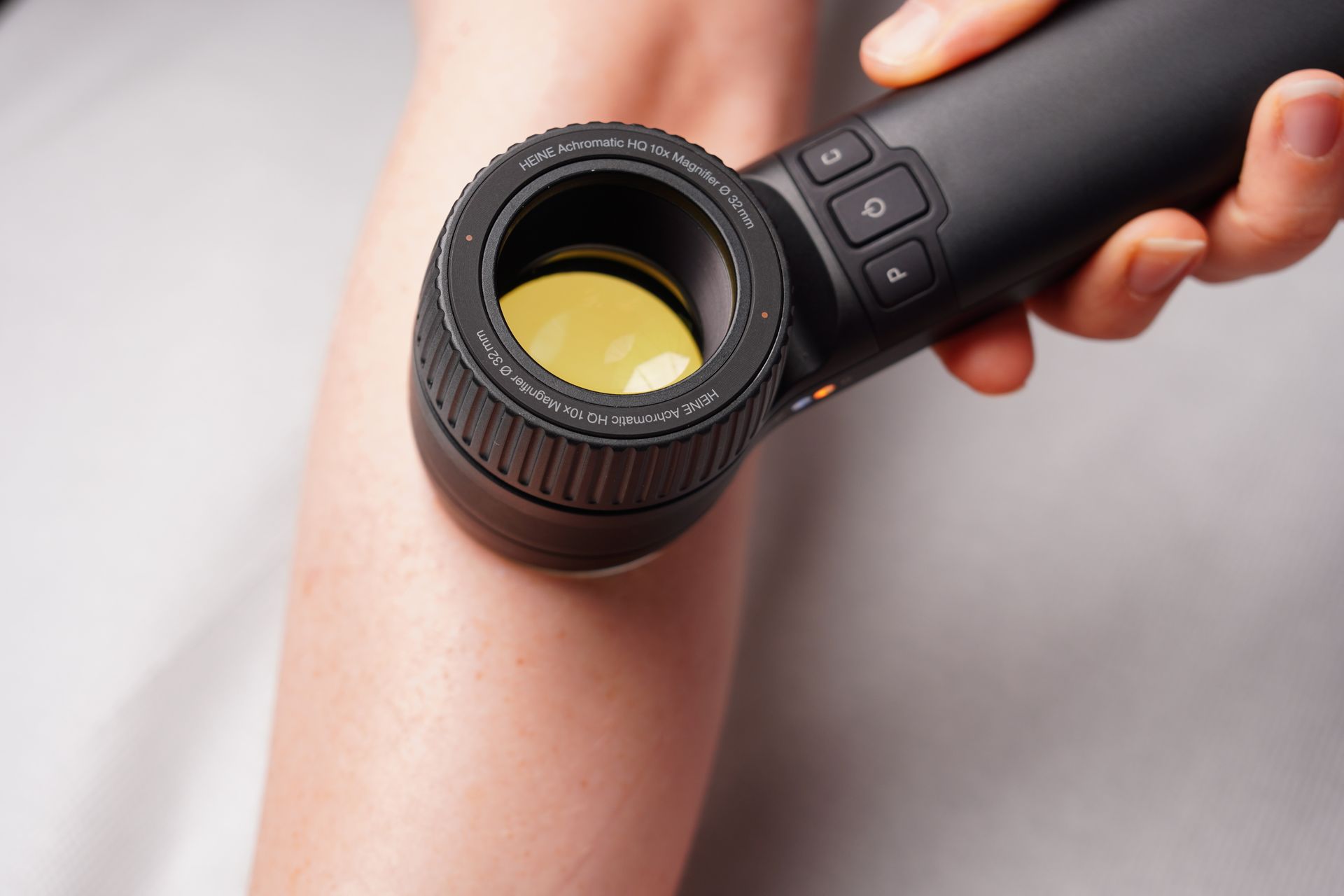 Undersøgelse af huden med dermatoskop. Dermatoskopet giver en stor forstørrelse og gør det muligt at stille en korrekt diagnose. 