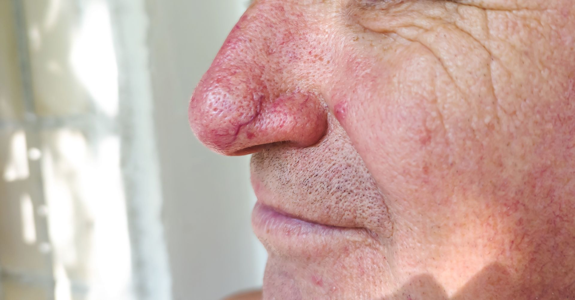 Rodd naese med synlige blodkar og begyndende fortykket hud ved rosacea hos en mand