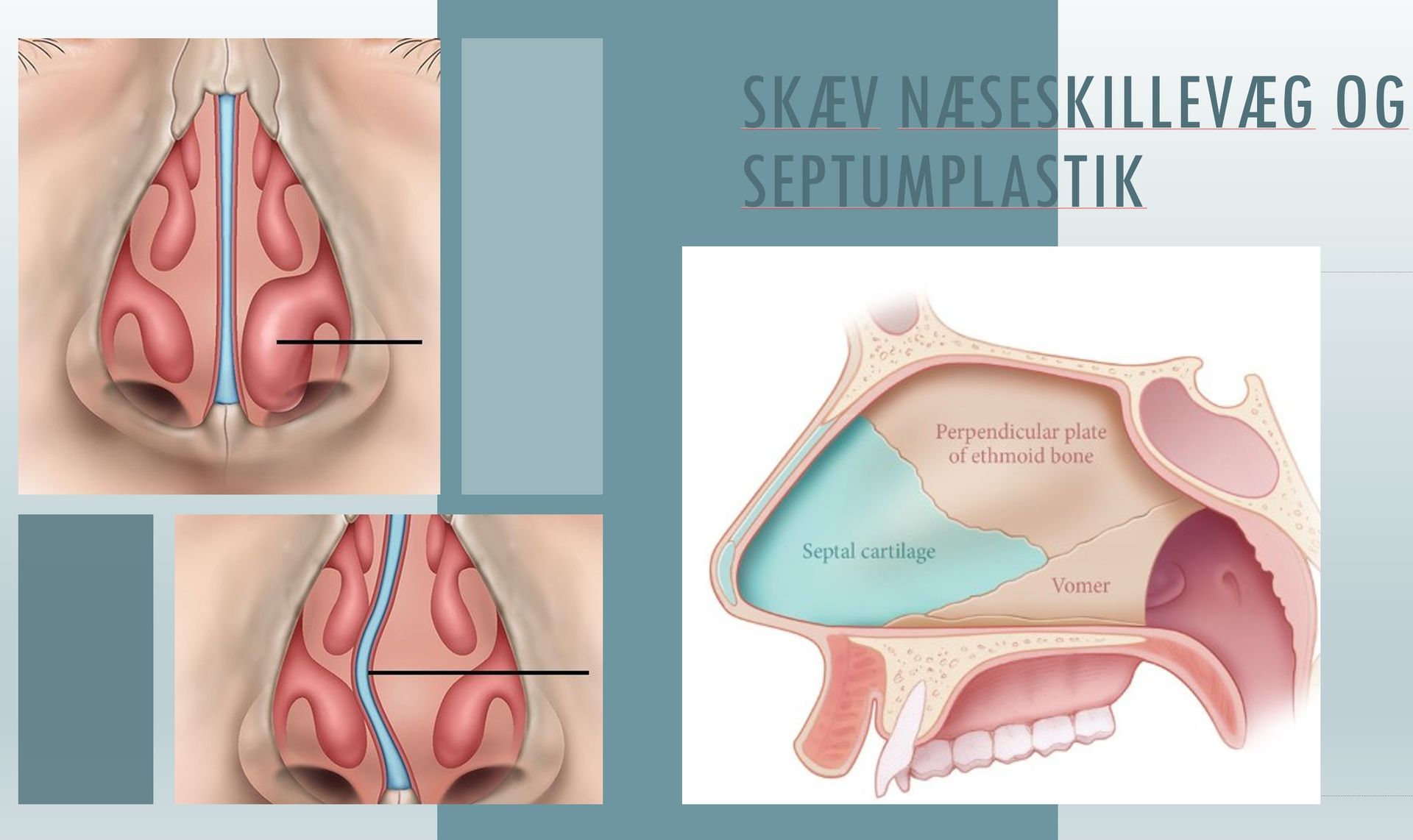 Diagram af næsen: illustrerer en lige næseskillevæg (øverst) og en buet næseskillevæg (nederst). Højre side viser et tværsnit af næsen.