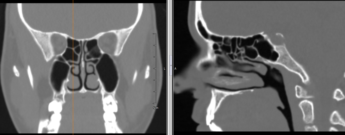 CT-scanning af bihulerne, der viser næsehulen og de omkringliggende knoglestrukturer.