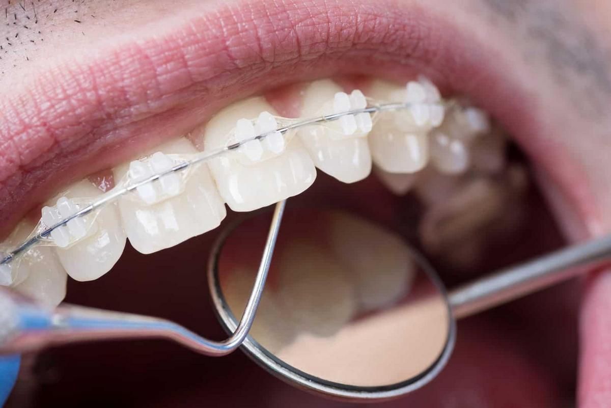 Aparelho de porcelana em detalhe
