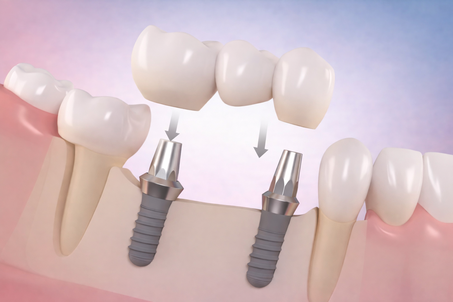 Prótese sobre implantes em modelo dentário