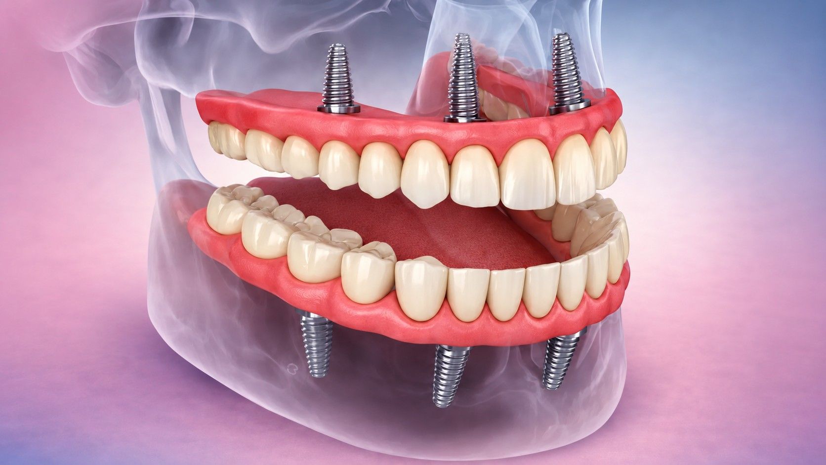 Simulação de um implante dentário All-on-4