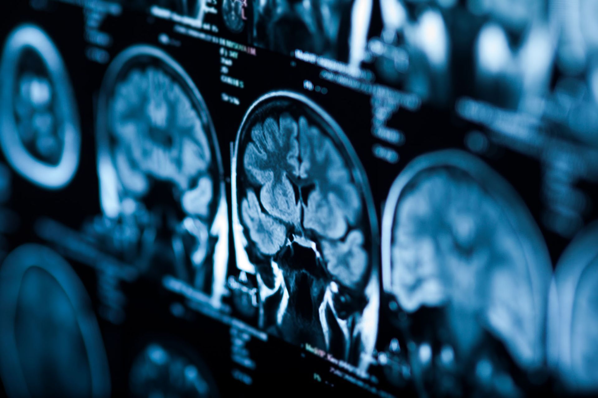 An X-ray of a human brain. An X-ray of a human brain.
