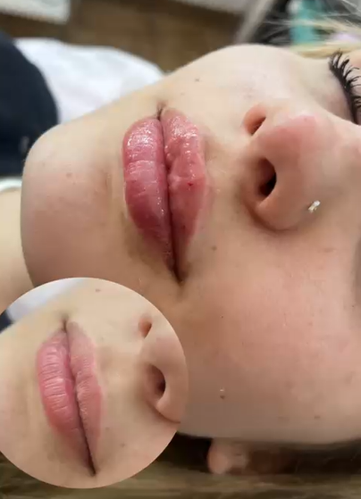 Relleno de labios