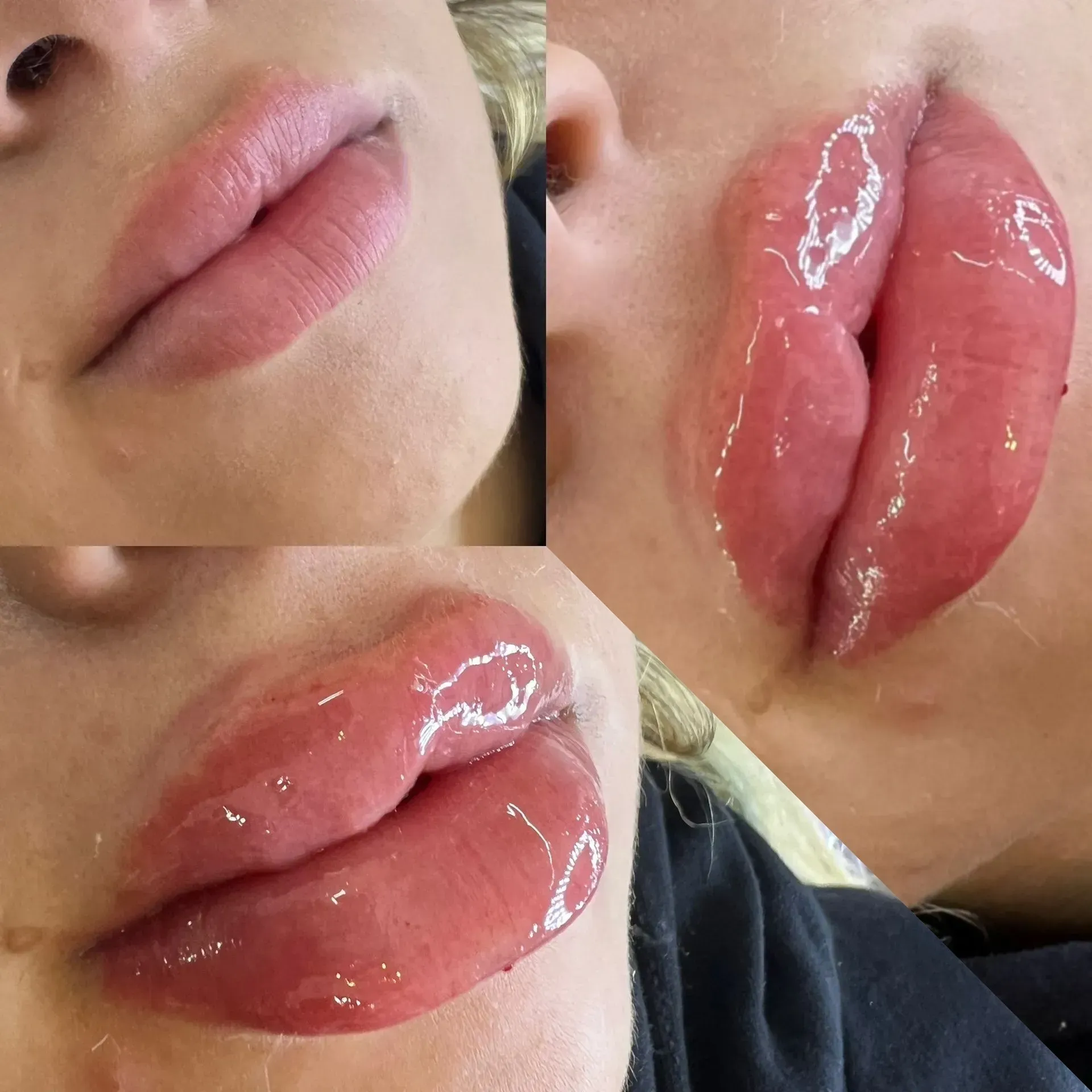 Labios con ácido hialurónico en Viviana Nails