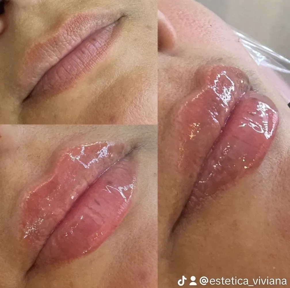 Labios con ácido hialurónico en Viviana Nails