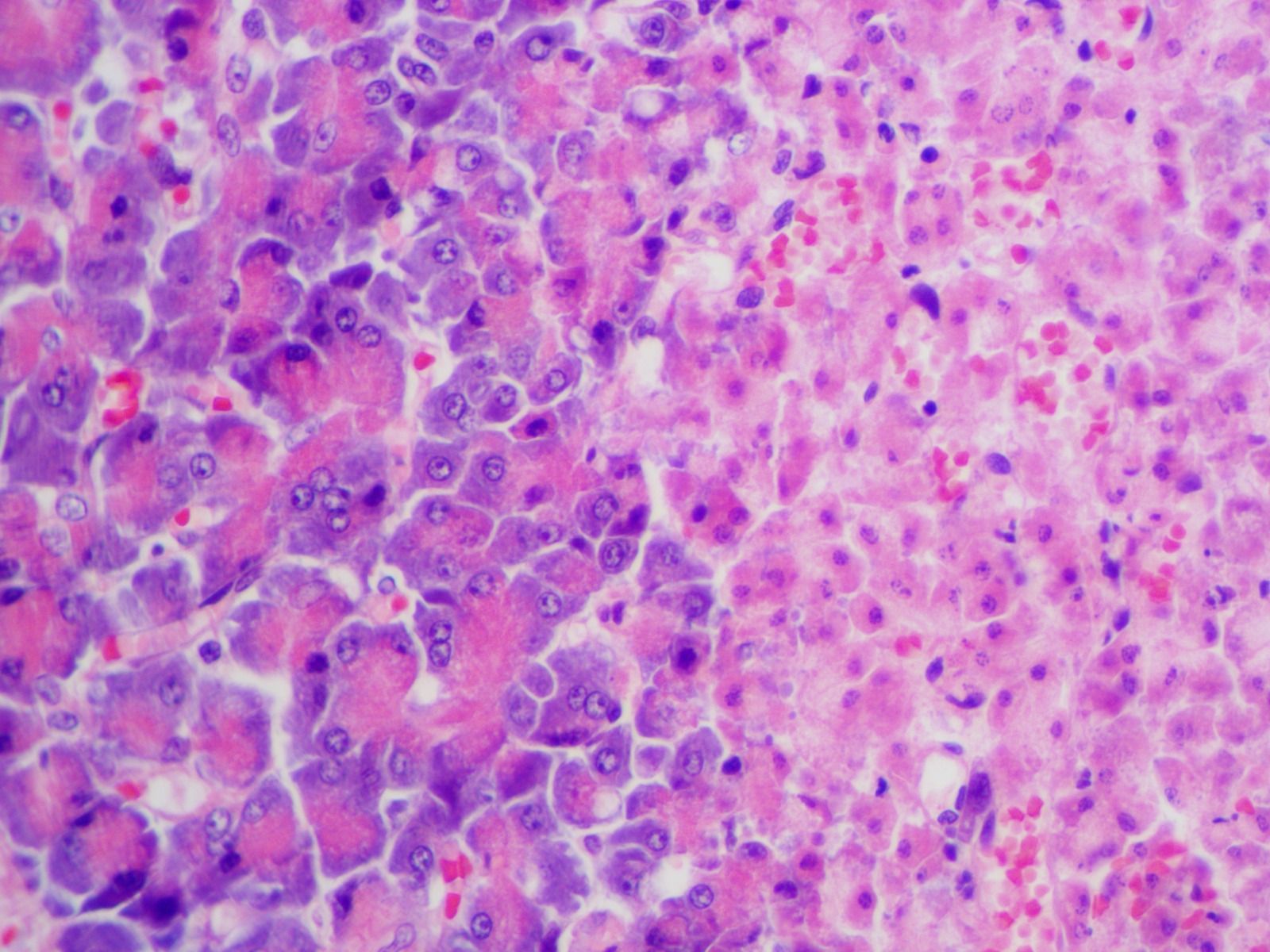 Vista microscópica del tejido pancreático que muestra una estructura normal a la izquierda y tejido necrótico (dañado) a la derecha.