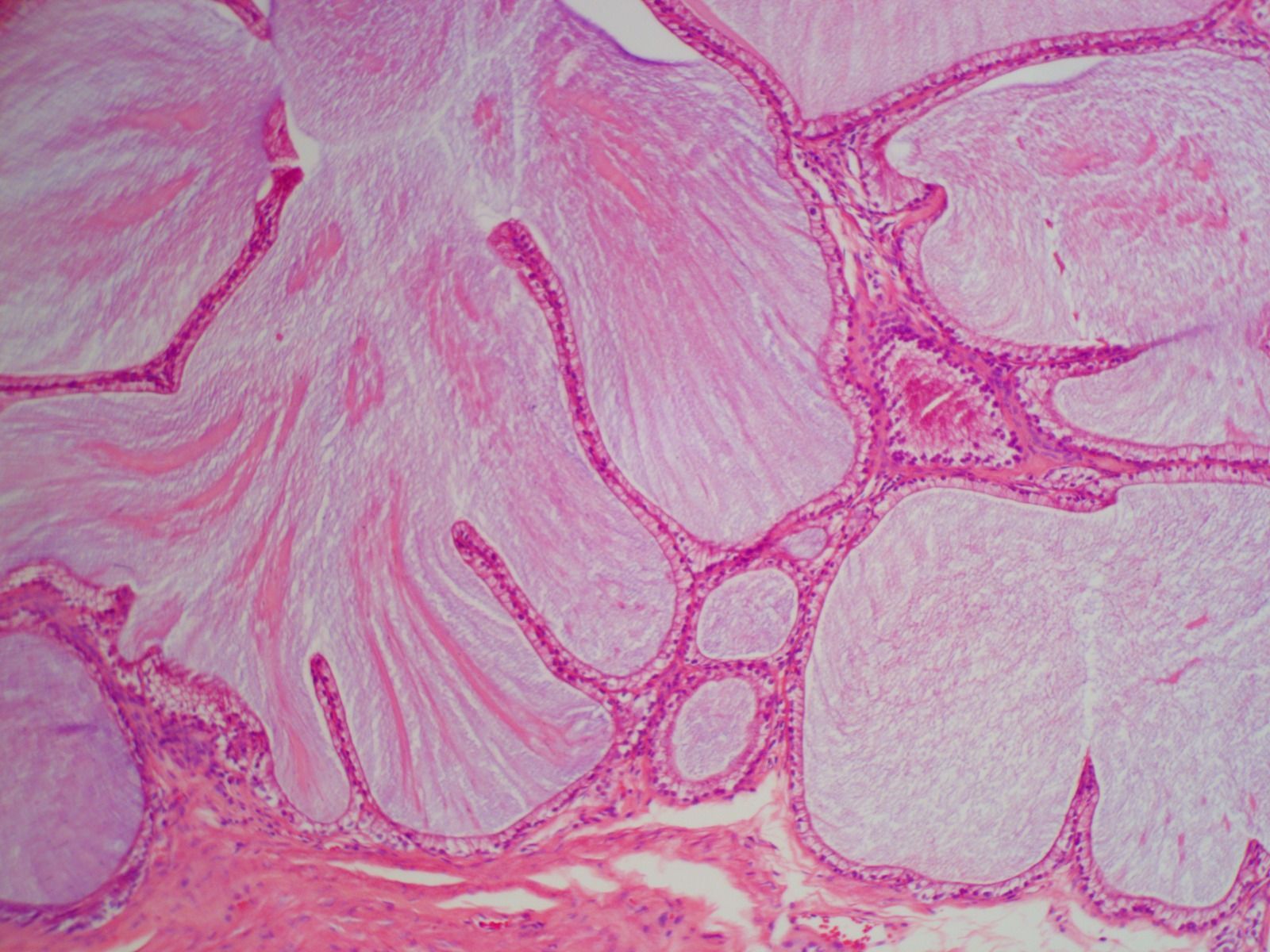 Imagen microscópica de una muestra de tejido biológico, que muestra estructuras rosadas, similares a quistes, con extensiones ramificadas.
