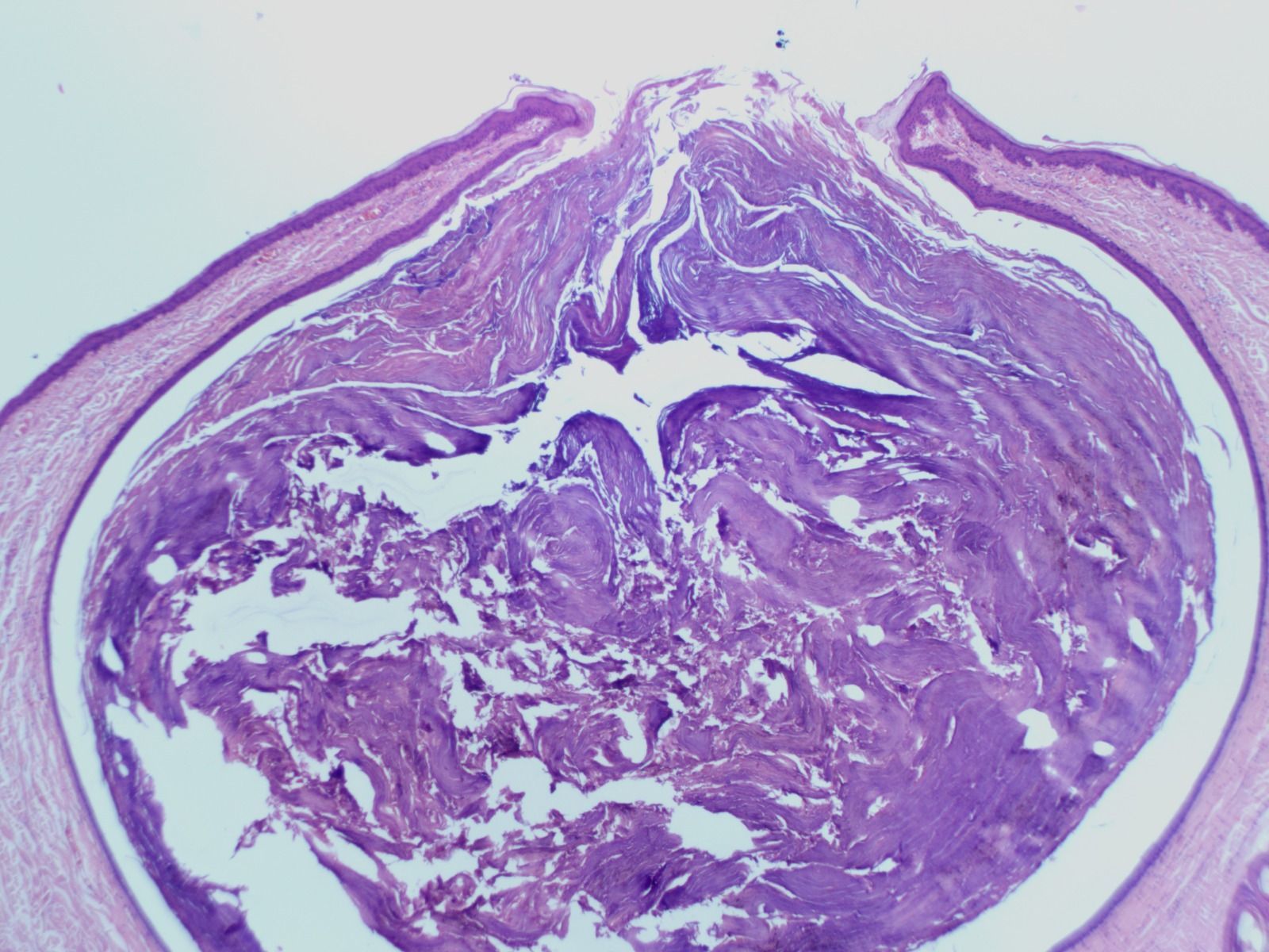 Corte transversal de piel que muestra un quiste grande de color rosa pálido con un centro colapsado y epidermis circundante.