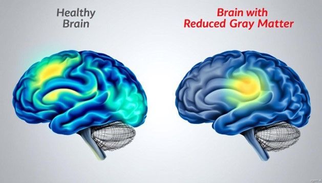 Diagram of a healthy brain (left) versus one with reduced gray matter (right), highlighted in yellow and blue.