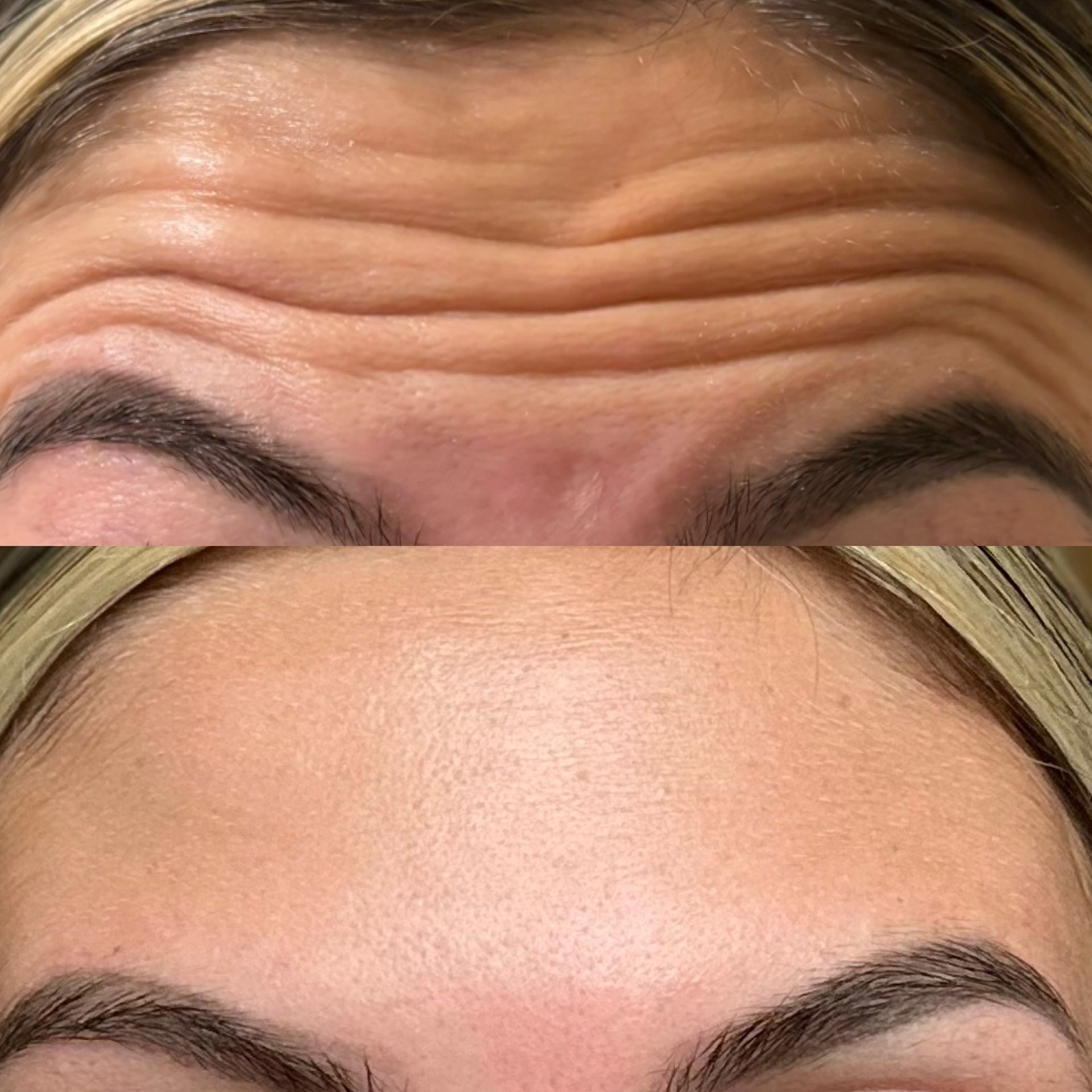 A before and after picture of a woman 's forehead with wrinkles.