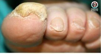Primo piano delle dita dei piedi con pelle spessa, gialla e ruvida sull'alluce