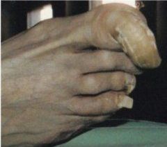 Primo piano di un piede nudo con unghie spesse e ingiallite e pelle ruvida, appoggiato su una superficie scura.