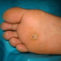 Primo piano della pianta di un piede con una piccola protuberanza simile a una verruca vicino al centro.
