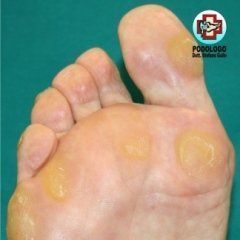 Primo piano della pianta di un piede con diverse vesciche gialle sulla pianta e sulle dita.