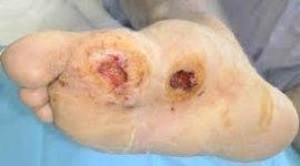 Piede con due piaghe o ferite circolari sul cuscinetto plantare, tenuta in una mano guantata di blu.