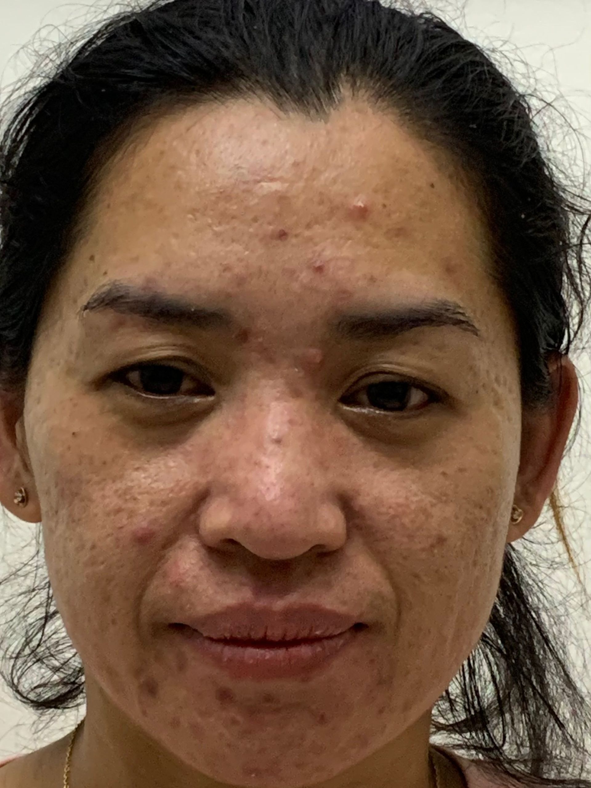 Woman with acne-scarred skin, small red spots, and dark spots on her face. Brown eyes, dark hair, neutral expression.