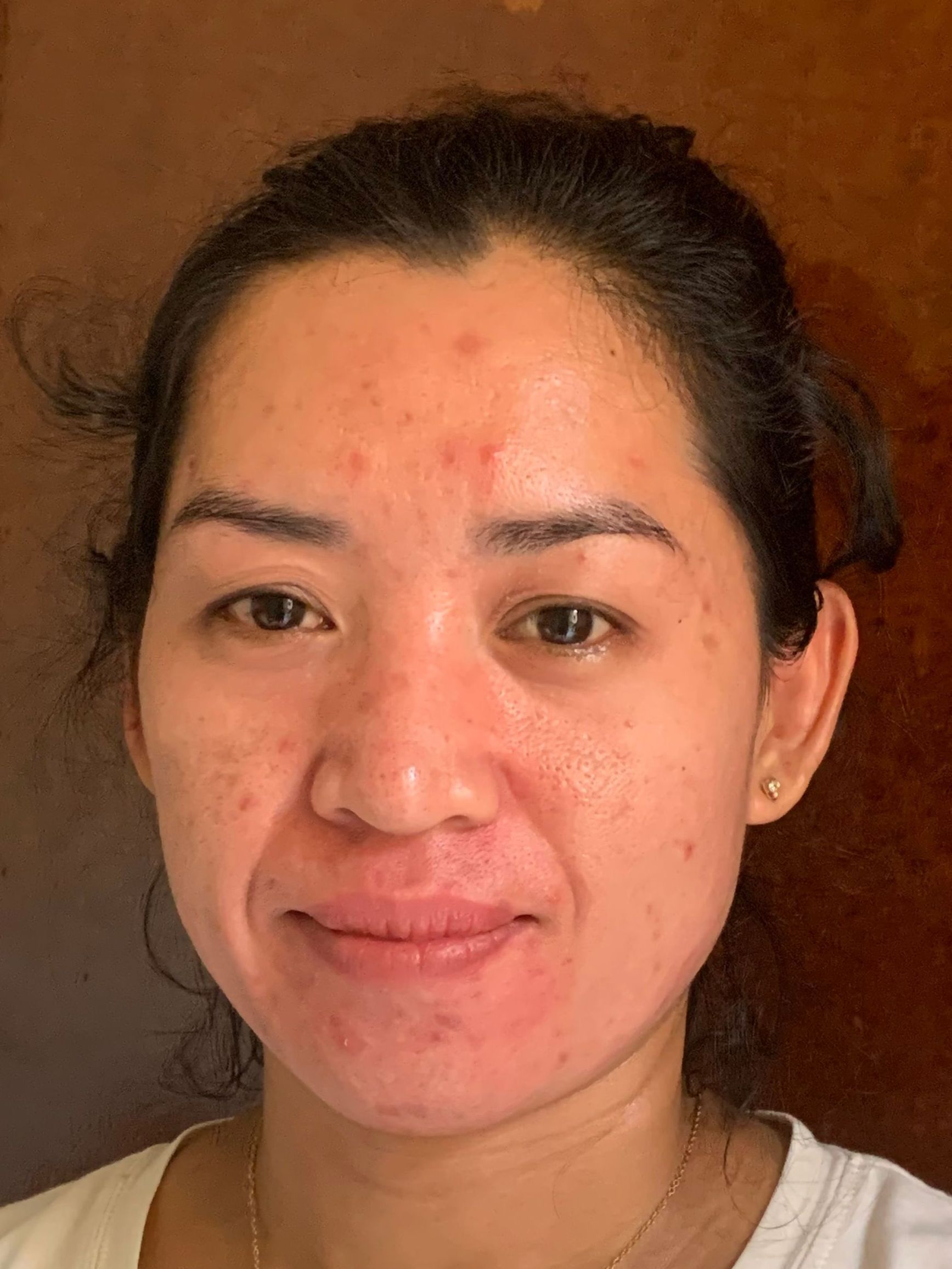 Woman with reddish skin and acne on her face; she smiles.
