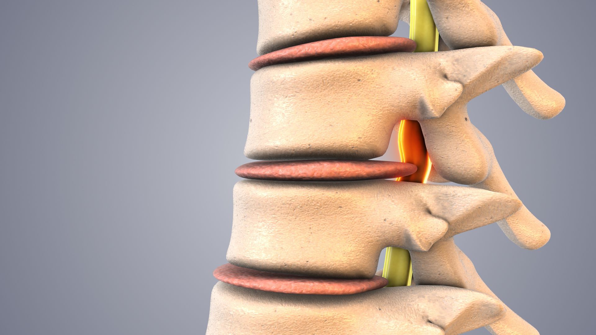 Lumbar disc and nerve compression illustration