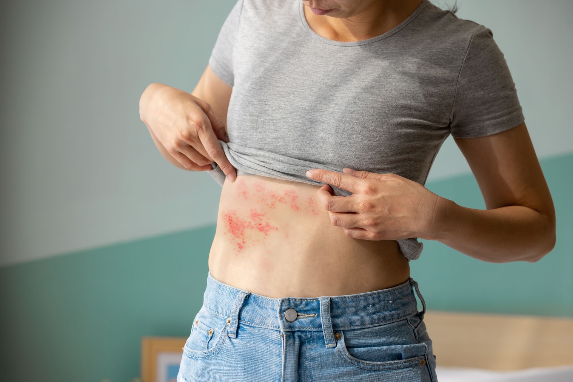 Mulher levanta a blusa para mostrar uma erupção cutânea vermelha e irritada no abdômen.