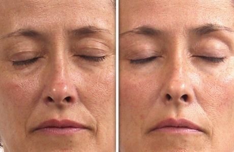 Before and after close-up of a face with wrinkles, then smoother skin, showing rejuvenation.