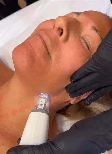 Person receiving a skin treatment on their neck, held by gloved hands. Redness visible.