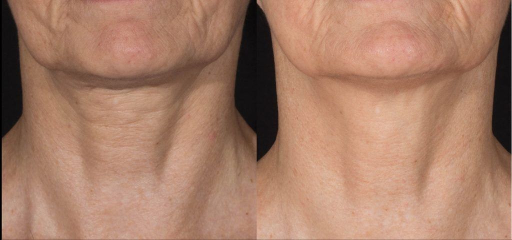 Before and after comparison of a neck with wrinkles, showing a smoother appearance after treatment.