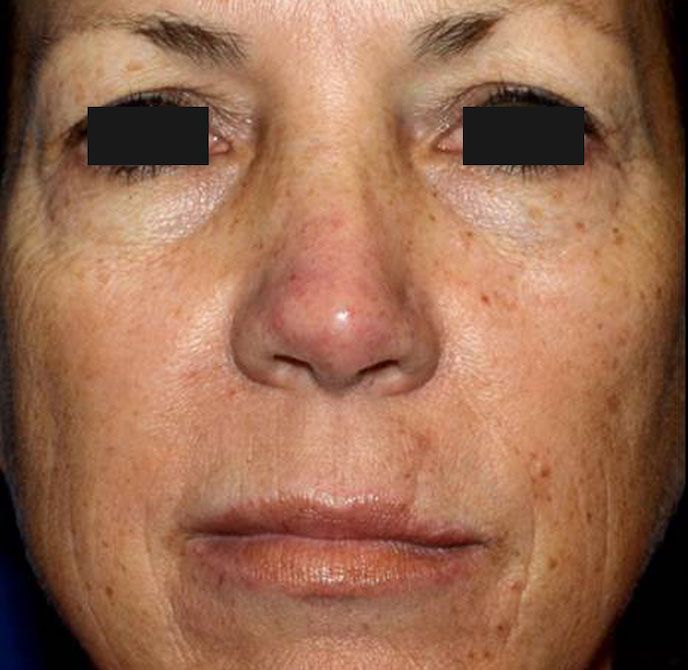 Close-up of a person's face with sun damage, visible freckles, and wrinkles around the eyes and mouth.