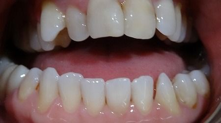 Open mouth showing upper and lower teeth, with gums visible