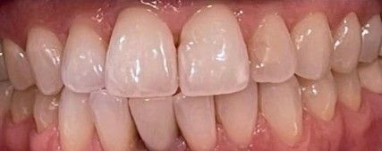 Close-up of healthy white teeth and pink gums in a smiling mouth