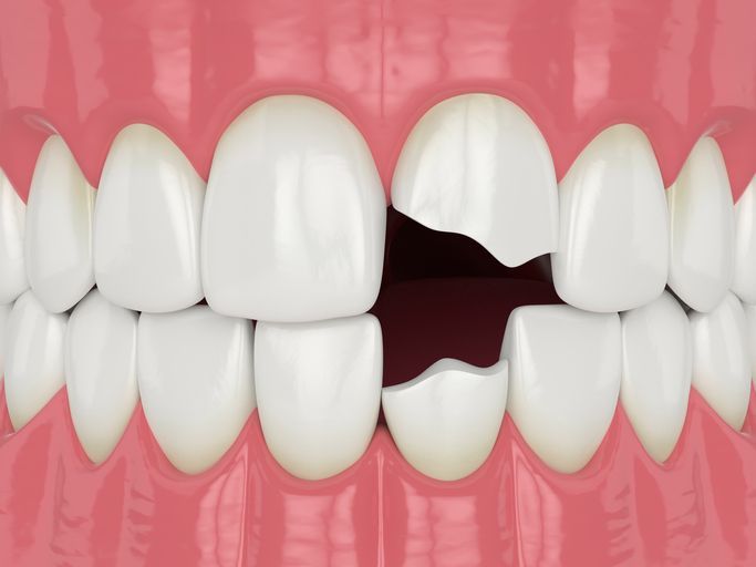 Illustration of teeth with a missing upper front tooth, showing a gap in a pink mouth.