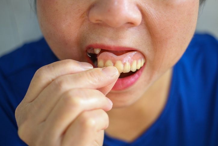 Partial Dentures