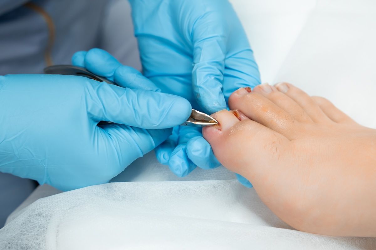 Podologist during the procedure of ingrown nail removal with nippers